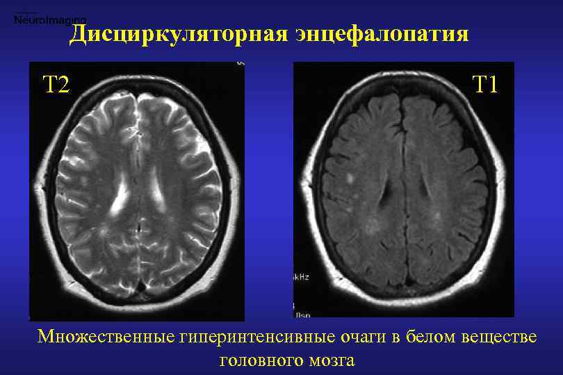 Энцефалопатия мозга 2 степени