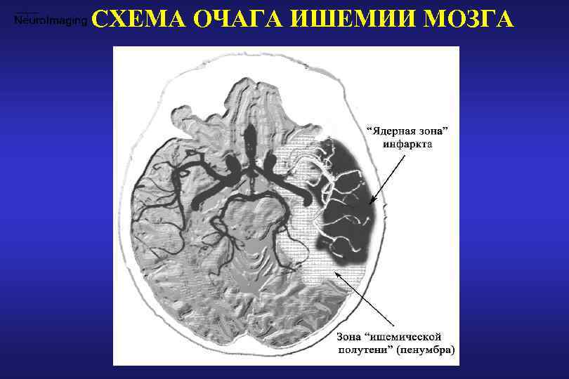 Что такое ишемия головного мозга