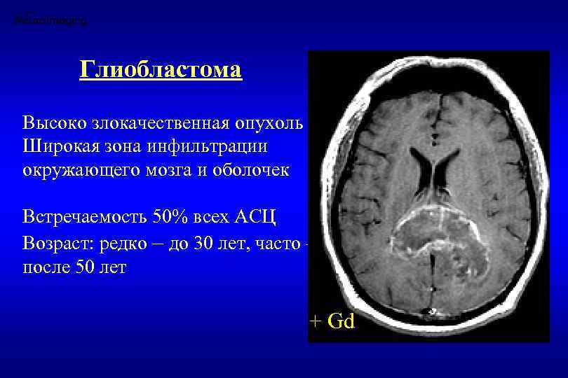 Глиобластома головного мозга фото