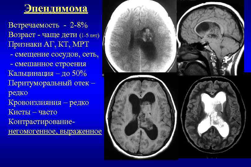 Эпендимома Встречаемость - 2 -8% Возраст - чаще дети (1 -5 лет) Признаки АГ,