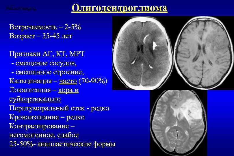 Олигодендроглиома Встречаемость – 2 -5% Возраст – 35 -45 лет Признаки АГ, КТ, МРТ