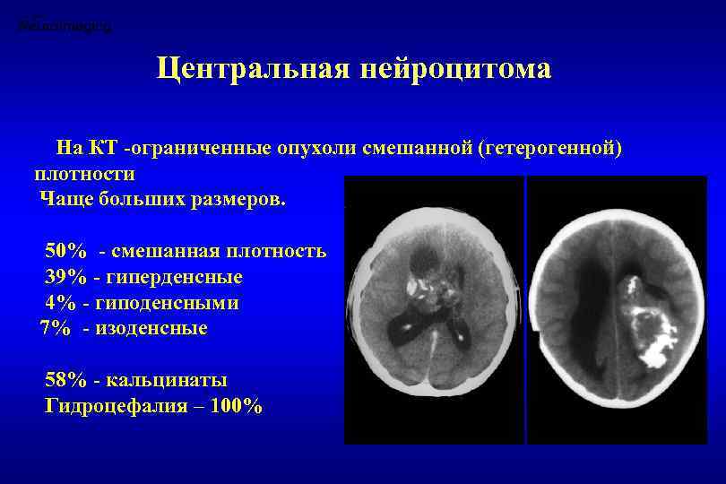 Плотный часто. Кальцинаты в головном мозге на кт. Опухоль головного мозга на кт. Объемное образование головного мозга.