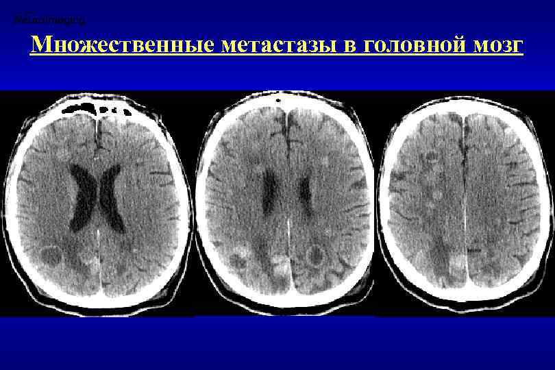 Лечение метастазов мозга. Первичные опухоли головного мозга. Отек головного мозга на фоне метастаз.