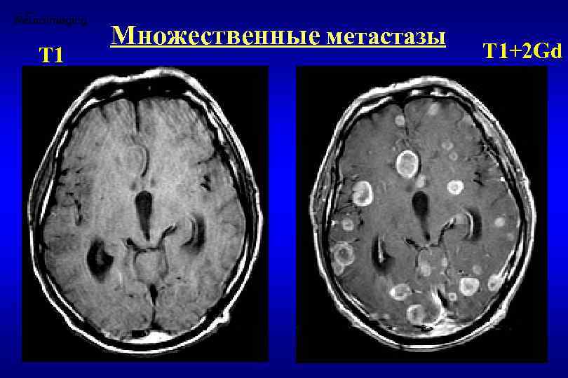 Т 1 Множественные метастазы Т 1+2 Gd 