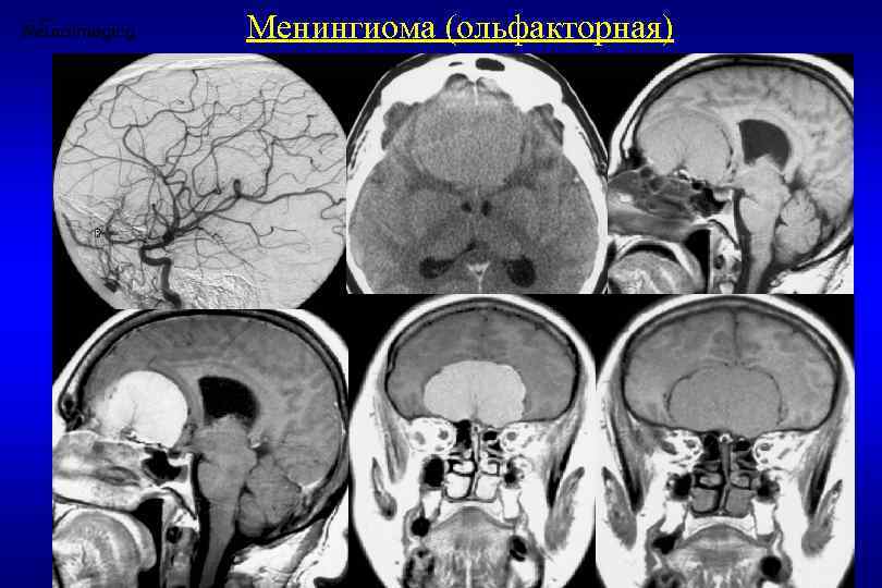 Менингиома головного мозга форум. Ольфакторная менингиома. Менингиома ольфакторной ямки кт.