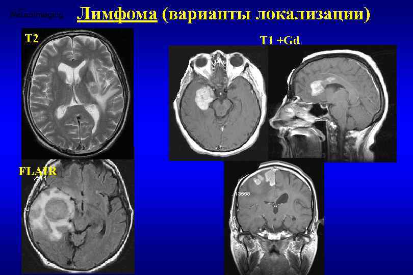 Лимфома (варианты локализации) Т 2 FLAIR T 1 +Gd 