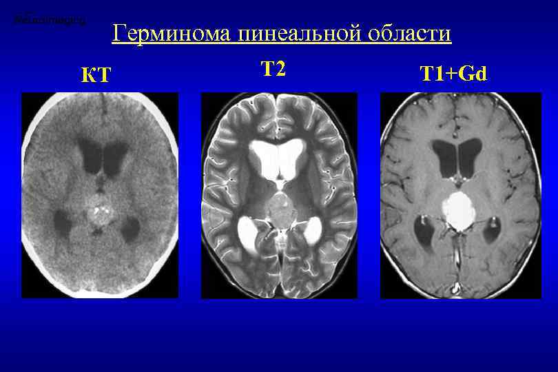 Герминома пинеальной области КТ Т 2 Т 1+Gd 