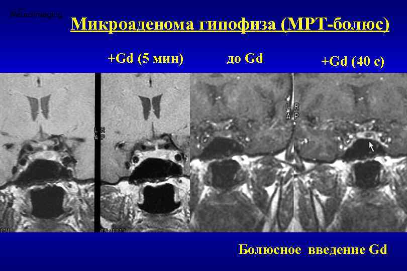 Микроаденома гипофиза (МРТ-болюс) +Gd (5 мин) до Gd +Gd (40 с) Болюсное введение Gd