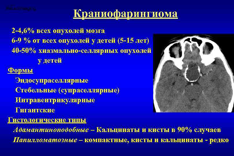 Краниофарингиома 2 -4, 6% всех опухолей мозга 6 -9 % от всех опухолей у