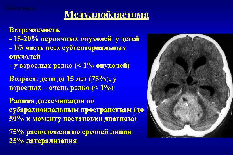 Медуллобластома Встречаемость - 15 -20% первичных опухолей у детей - 1/3 часть всех субтенториальных