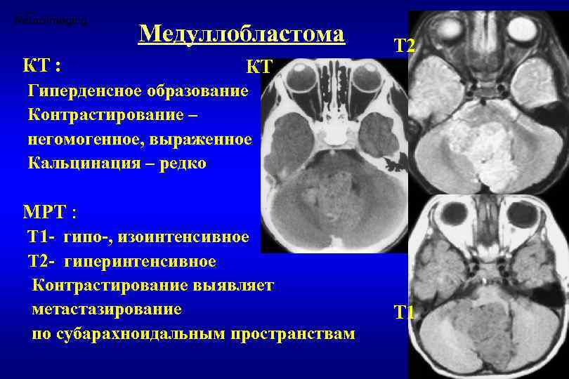 Гиперденсный участок в серошкальном изображении