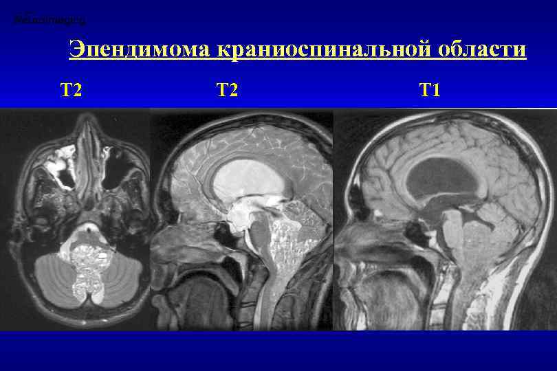 Эпендимома краниоспинальной области Т 2 Т 1 