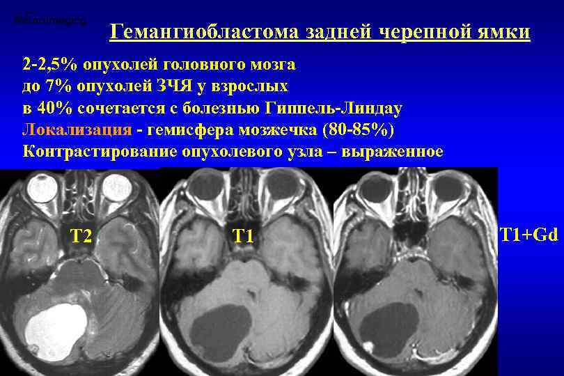 Средняя киста