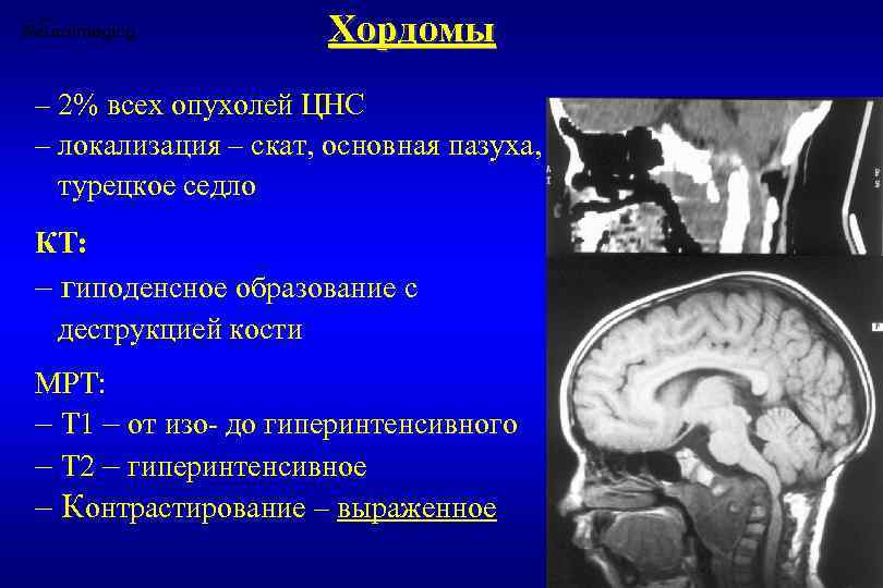 Хордомы – 2% всех опухолей ЦНС – локализация – скат, основная пазуха, турецкое седло