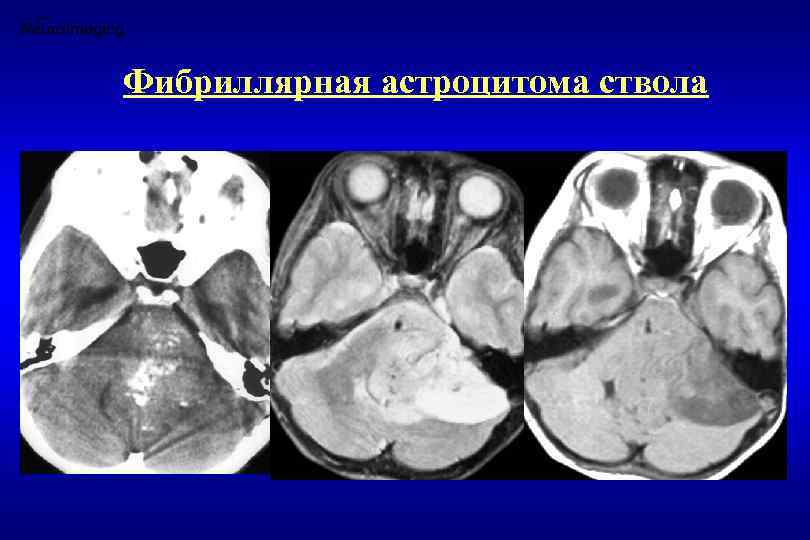 Фибриллярная астроцитома ствола 