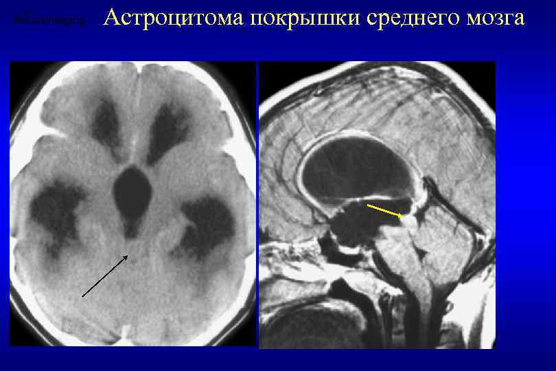 Астроцитома покрышки среднего мозга 