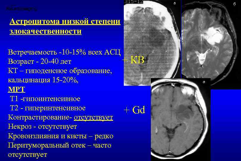 Глиома степени злокачественности. Мультифокальная астроцитома. Анапластическая астроцитома лобной доли. Астроцитома головного мозга кт. Пилоцитарная астроцитома мозжечка.