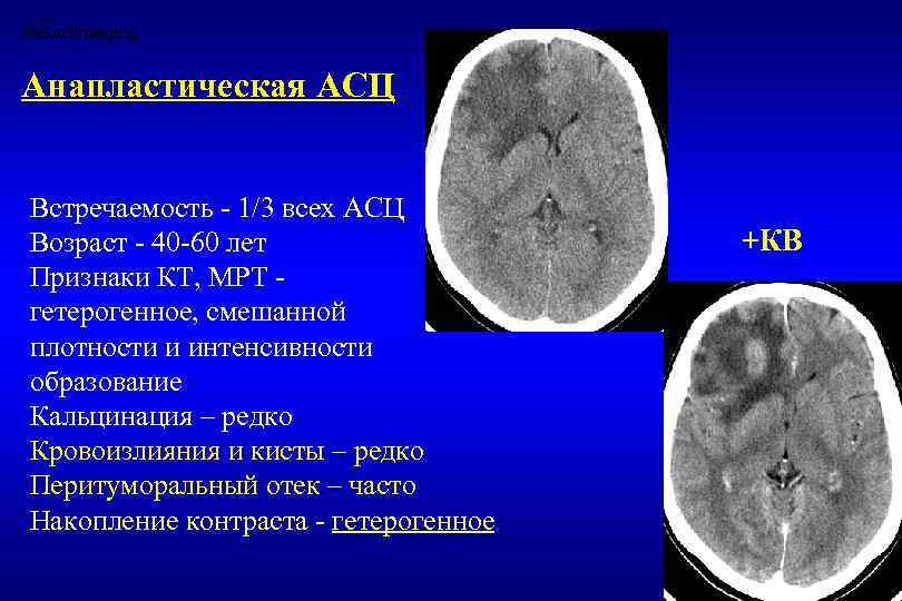 Образование в мозгу. Образование головного мозга кт. Кистозные образования головного мозга кт.