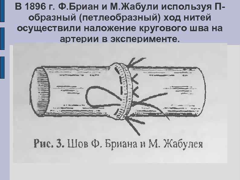 Сосудистый шов методы наложения. Сосудистый шов Гросса Жабулея. П-образный сосудистый шов. Наложение сосудистого шва.