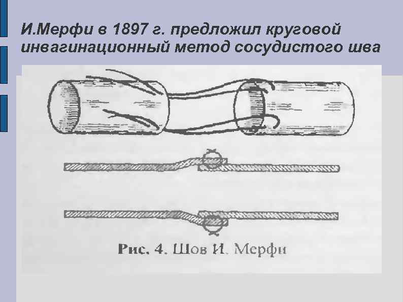 И. Мерфи в 1897 г. предложил круговой инвагинационный метод сосудистого шва 