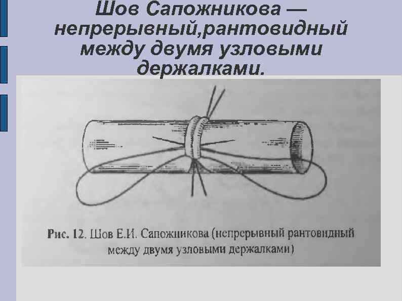 Сосудистый шов методы наложения. Шов Сапожникова сосудистый. Сосудистый шов топографическая анатомия. Непрерывный сосудистый шов. Наложение сосудистого шва.