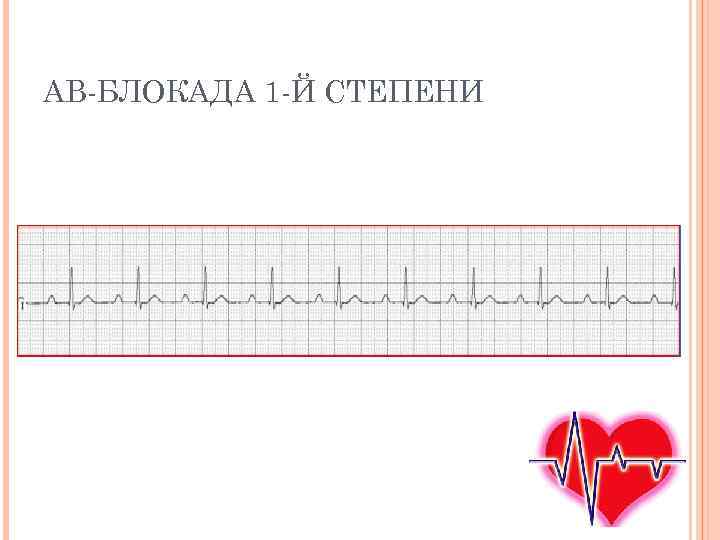 Блокада том 1. Av блокада 1 степени. Атриовентрикулярная блокада 1 степени. Блокада 1 й степени. АВ-блокада 1 степени и бктта блоксторы.