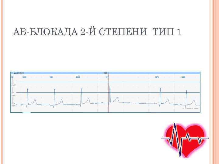 АВ-БЛОКАДА 2 -Й СТЕПЕНИ ТИП 1 