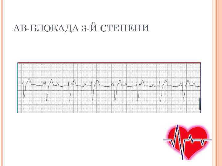 Ав блокада 3 степени на экг картинки