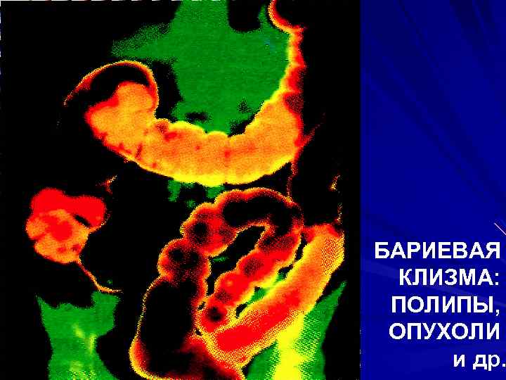 БАРИЕВАЯ КЛИЗМА: ПОЛИПЫ, ОПУХОЛИ и др. 