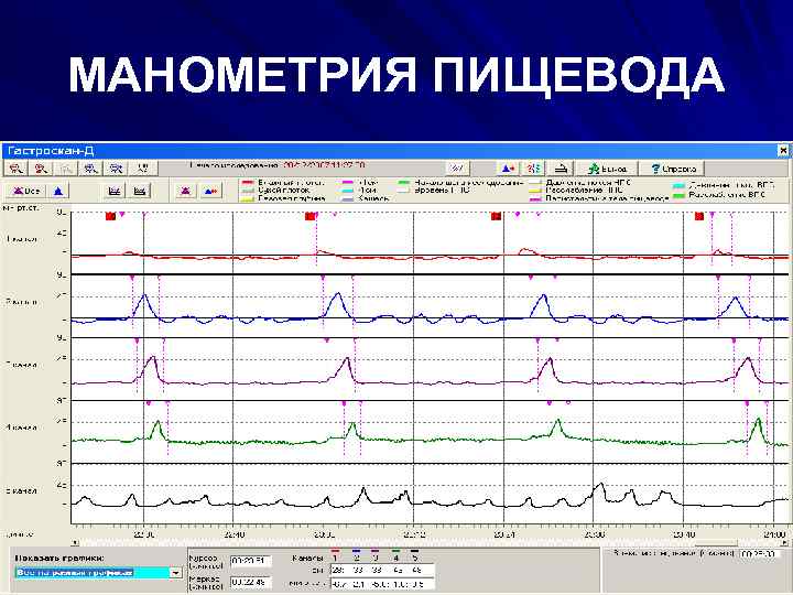 МАНОМЕТРИЯ ПИЩЕВОДА 