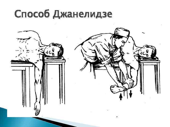 Способ Джанелидзе 