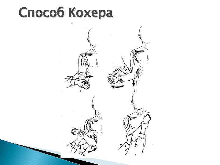 Способ Кохера 