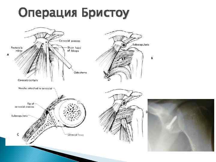 Операция Бристоу 
