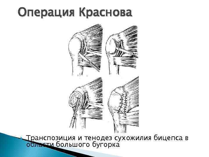 Вывих плечевого сустава локальный статус карта вызова скорой