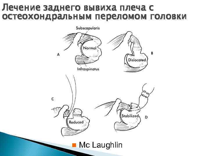 Лечение заднего вывиха плеча с остеохондральным переломом головки n Mc Laughlin 