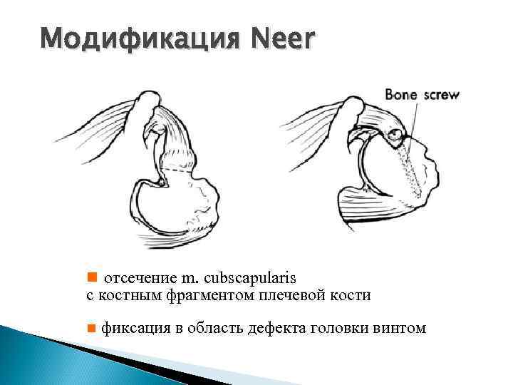 Модификация Neer n отсечение m. cubscapularis с костным фрагментом плечевой кости n фиксация в