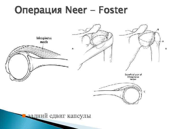 Операция Neer - Foster n задний сдвиг капсулы 