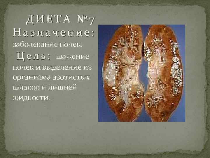  ДИЕТА № 7 Назначение: заболевание почек. Ц е л ь : щажение почек