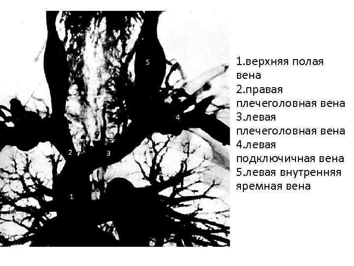 5 5 4 2 3 1 1. верхняя полая вена 2. правая плечеголовная вена