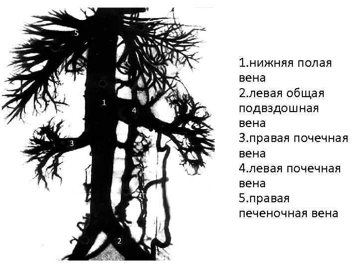 4 2 1. нижняя полая вена 2. левая общая подвздошная вена 3. правая почечная