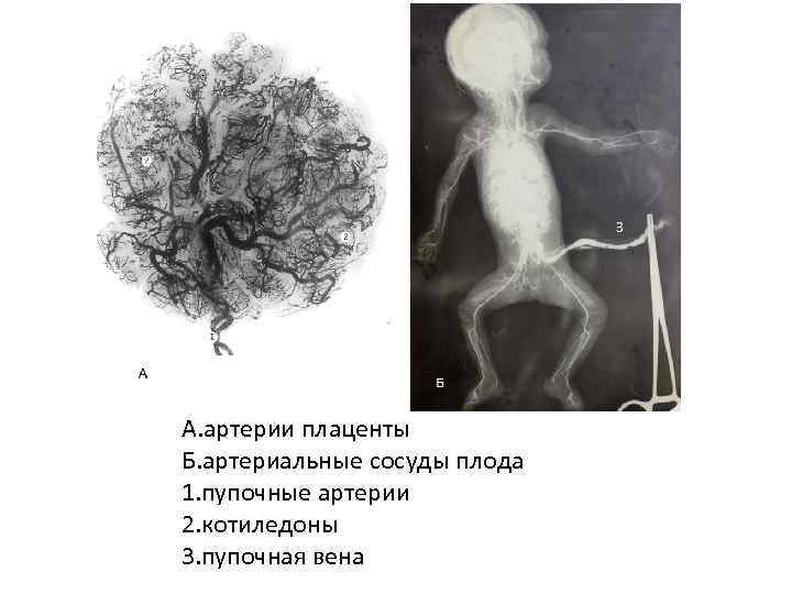 3 А. артерии плаценты Б. артериальные сосуды плода 1. пупочные артерии 2. котиледоны Б