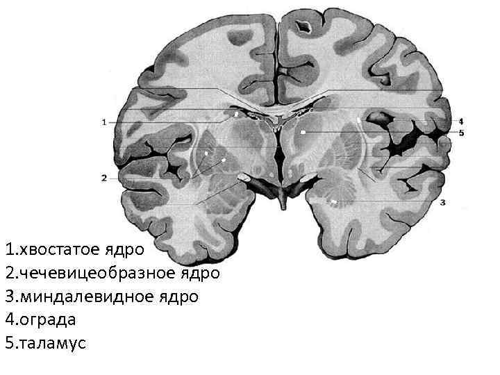 Хвостатое ядро мозга. Хвостатое и чечевицеобразное ядро. Хвостатое ядро анатомия. Хвостатое ядро головного мозга анатомия. Чечевицеобразное ядро мозга анатомия.