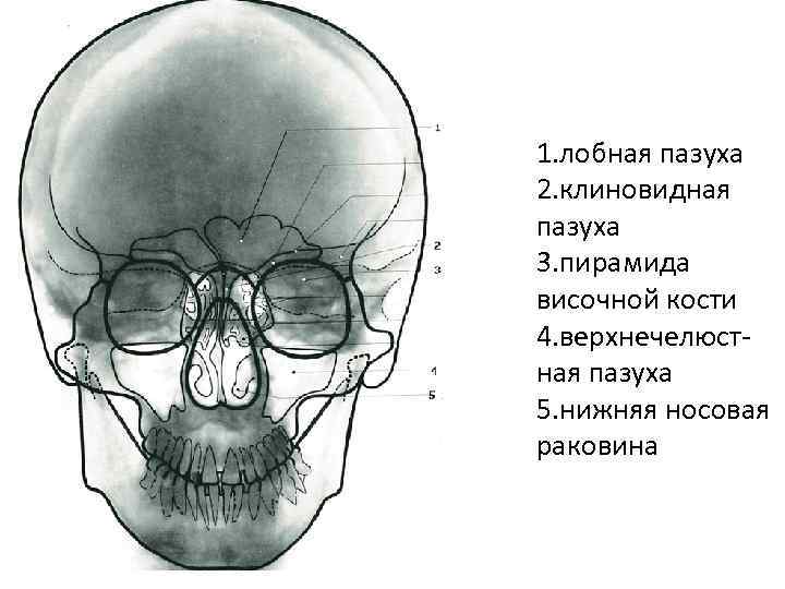 Лобная пазуха. Строение черепа лобные пазухи. Воздухоносная лобная пазуха. Лобная пазуха лобной кости. Апертуры лобной пазухи анатомия.