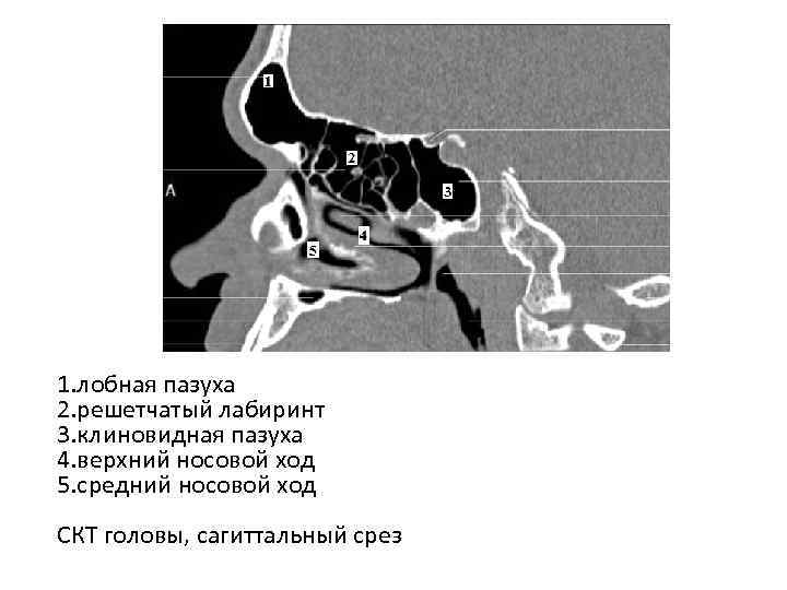 С чем граничит верхняя стенка клиновидной пазухи