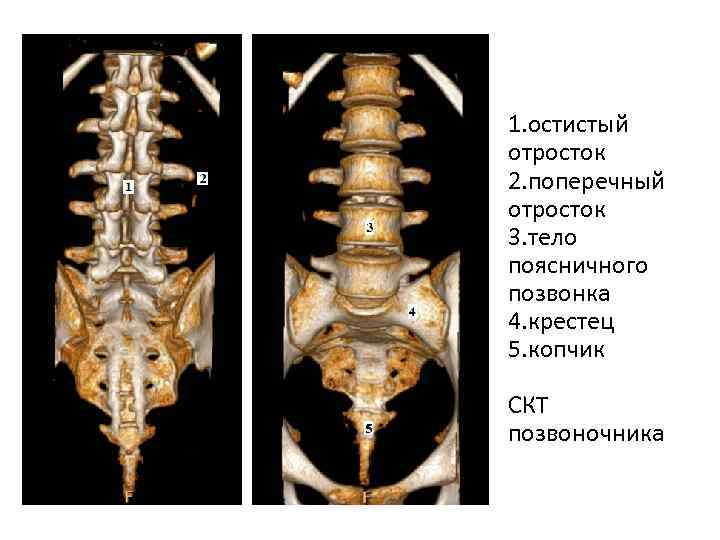 Переходный поясничный позвонок