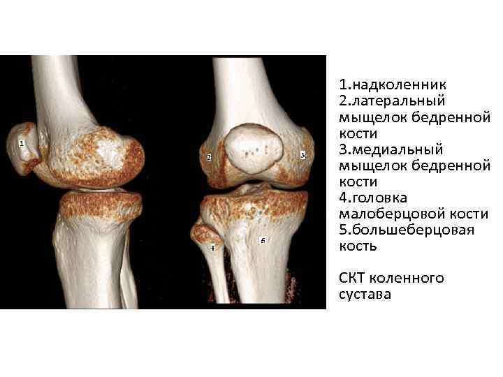 1. надколенник 2. латеральный мыщелок бедренной кости 3. медиальный мыщелок бедренной кости 4. головка