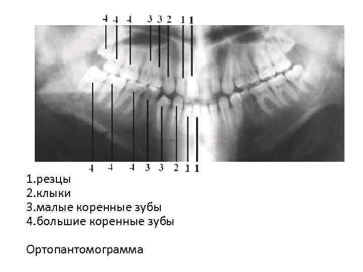 1. резцы 2. клыки 3. малые коренные зубы 4. большие коренные зубы Ортопантомограмма 