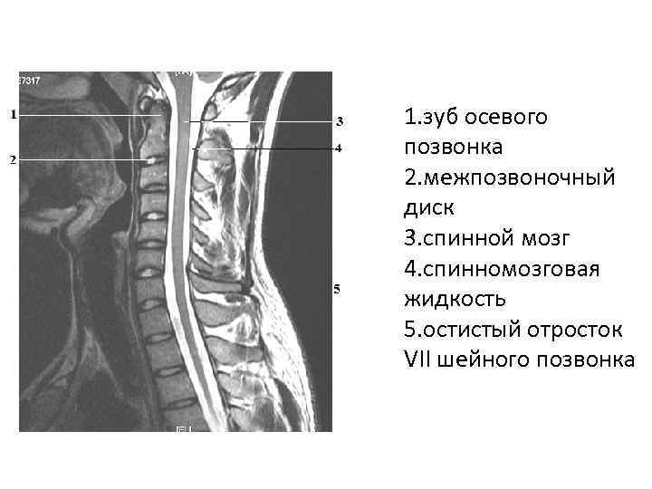 1. зуб осевого позвонка 2. межпозвоночный диск 3. спинной мозг 4. спинномозговая жидкость 5.