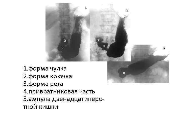 5 4 1. форма чулка 2. форма крючка 3. форма рога 4. привратниковая часть