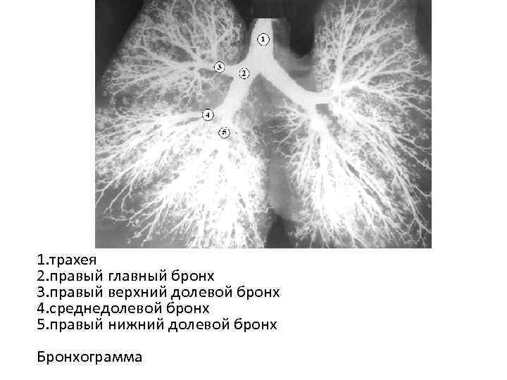 1. трахея 2. правый главный бронх 3. правый верхний долевой бронх 4. среднедолевой бронх